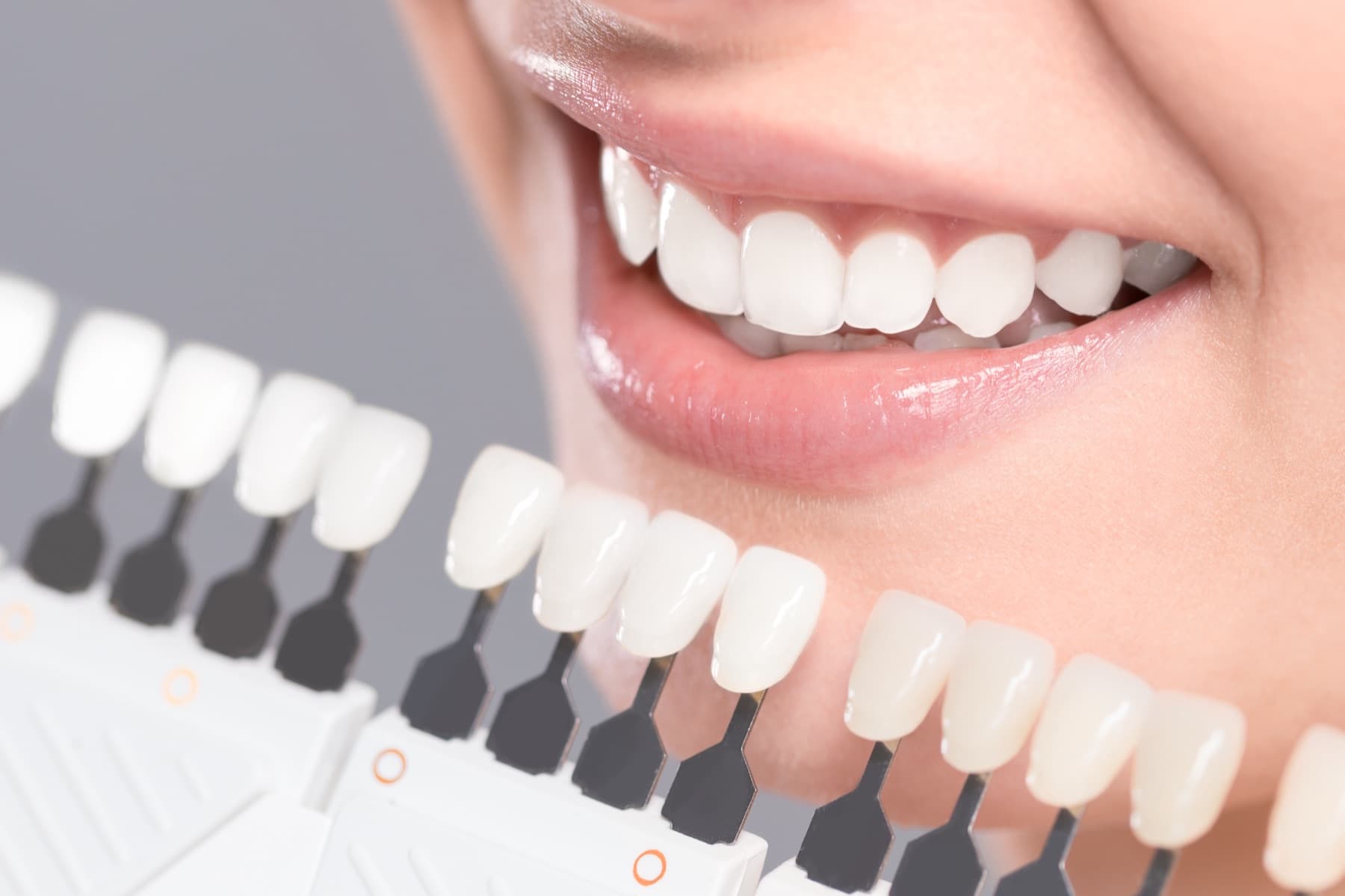 Hauchdünne Keramik-Veneers – Densante Berlin